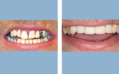 Before and After